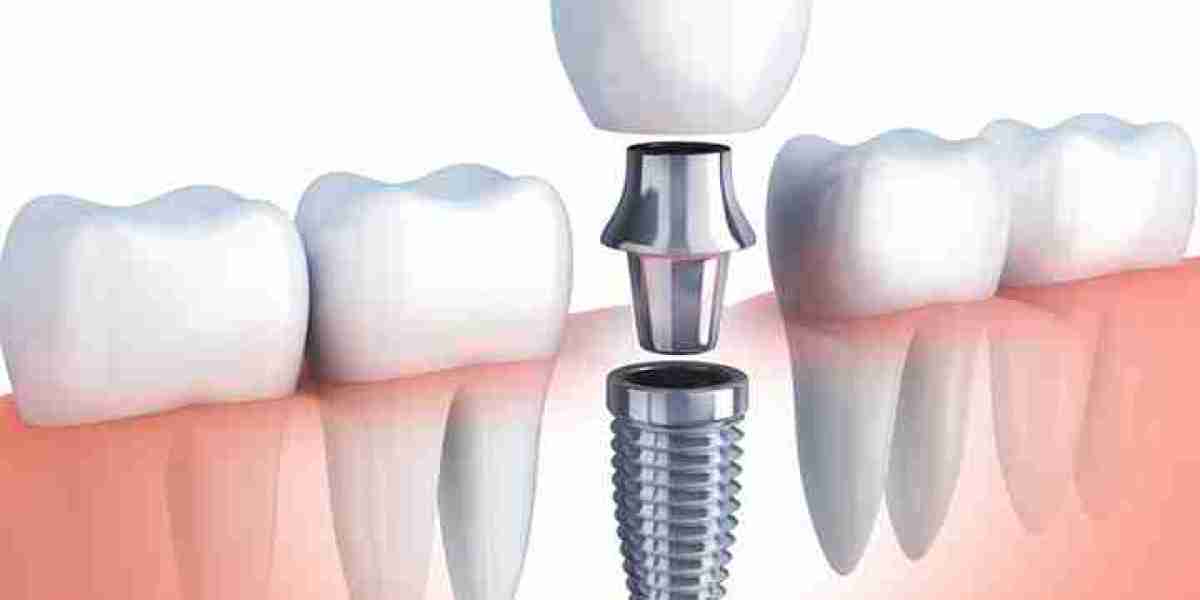 Gắn implant có đau không? Giải pháp hiện đại tại Nha khoa Sing