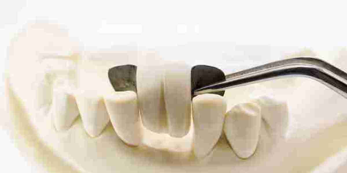 Are Dental Bridges a Good Option for Replacing Missing Teeth?