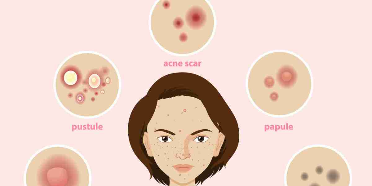 Understanding Acne: Causes, Triggers, and Effective Treatments