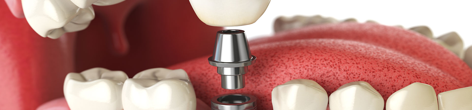 Quality Dental Implants in Cabot, AR | Restore Missing Teeth