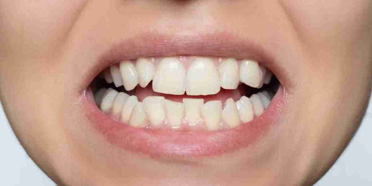 Is Teeth Whitening Safe for People with Dental Work?