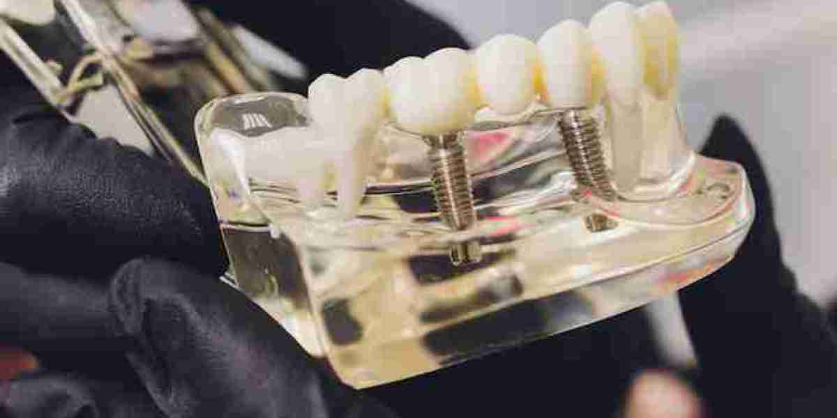 What Is an Implant-Supported Bridge? Understanding This Innovative Solution