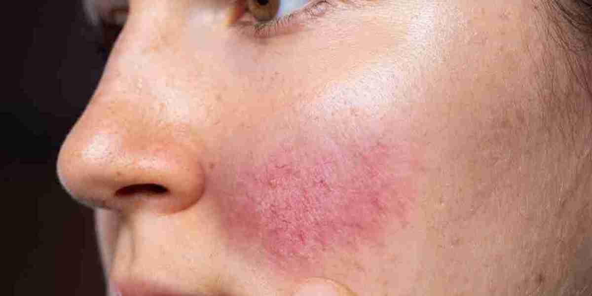 Finding the Right Rosacea Treatment for Your Skin Type in Islamabad