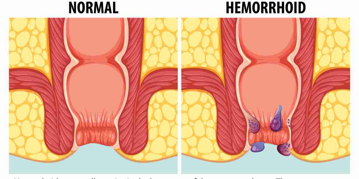 Addressing Hemorrhoids: When to See a Doctor