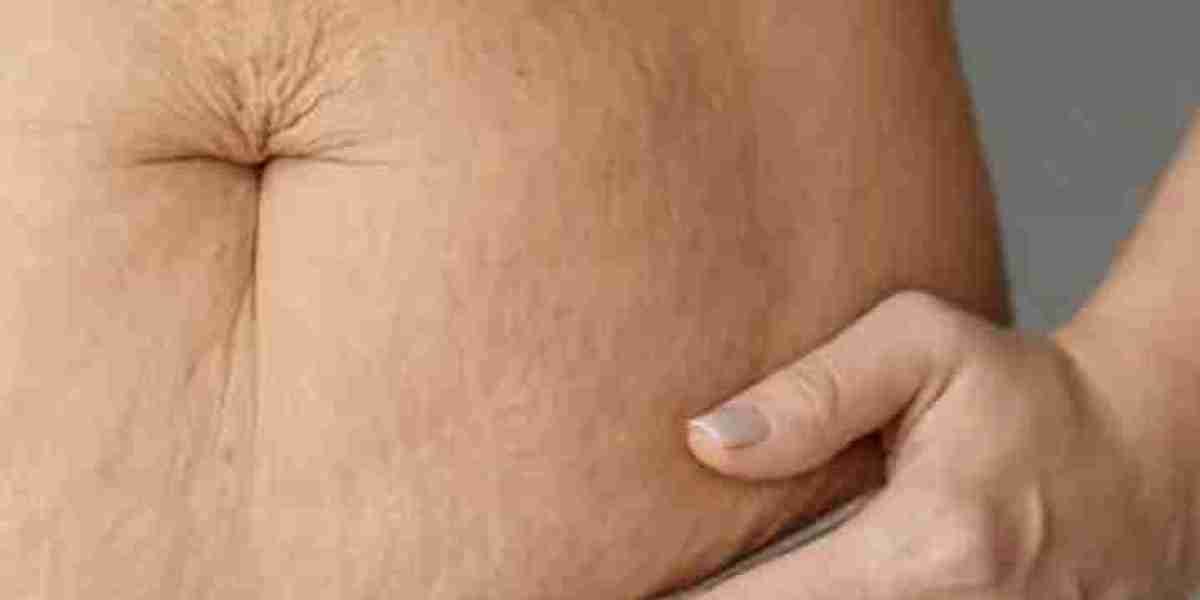 Stretch Marks Treatment In Delhi