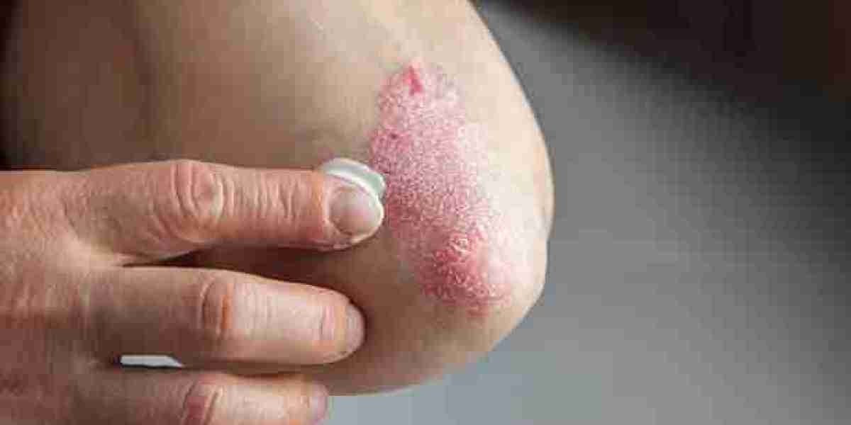 Best Psoriasis Specialists in Bangalore: Find Your Solution Today