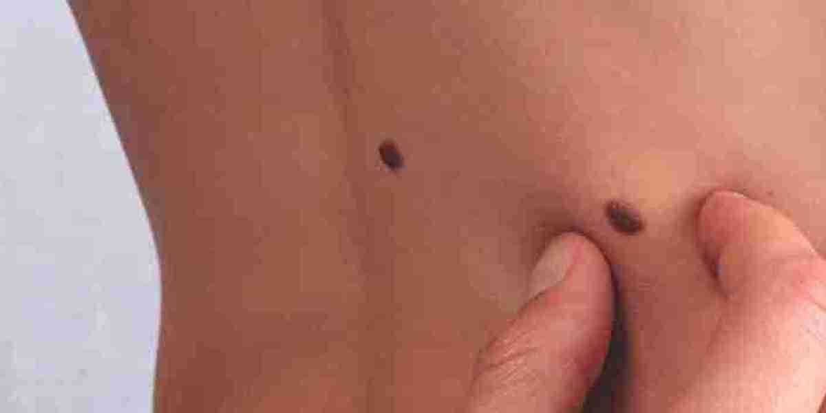 Is Skin Tag Removal Permanent or Can They Reappear?