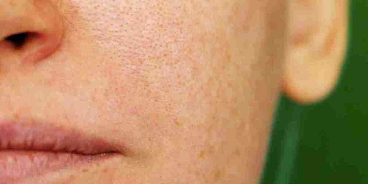 Analyzing Treatment Costs for Managing Large Pores Effectively