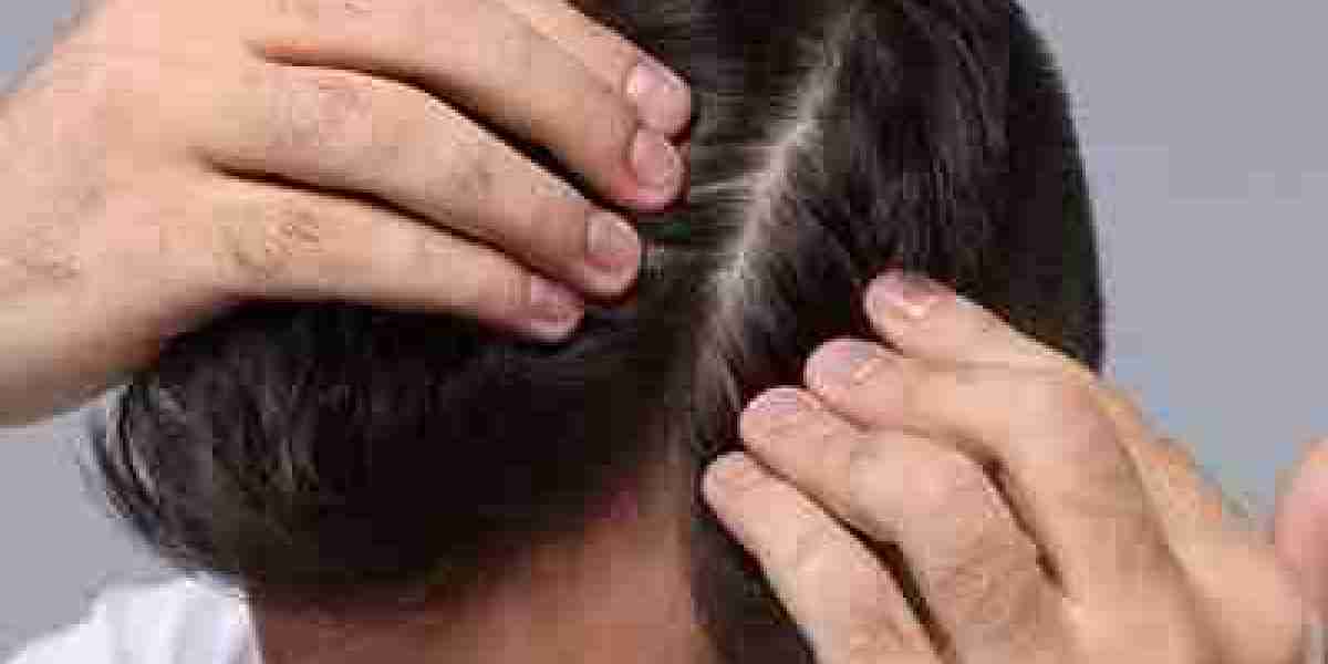 The Pros and Cons of Getting a Hair Transplant in Islamabad