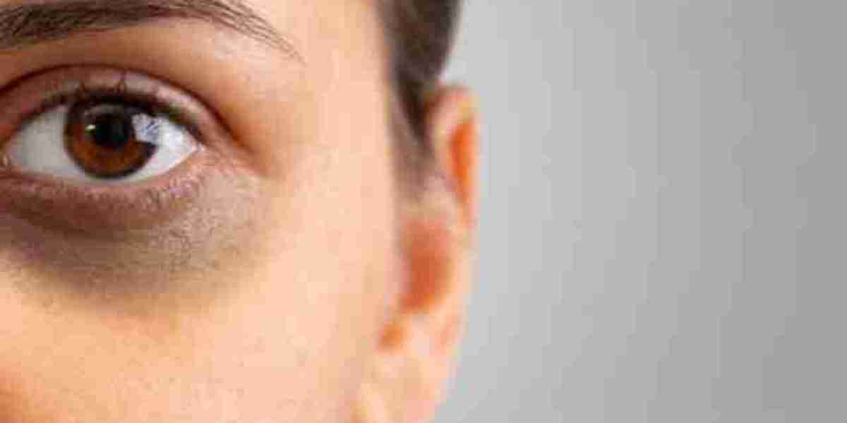 Get Rid Of Dark Circles Under Eyes With Promising Treatments! | Kosmoderma Clinic in Bangalore