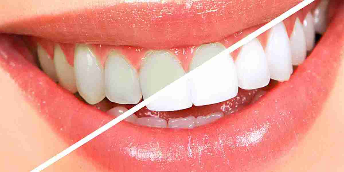 Teeth Whitening Services in Dubai: Are You Ready to Transform Your Smile?