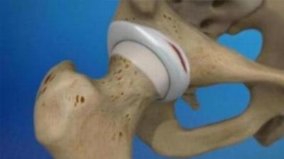 Labral Tear of Hip Treatment in Ranchi | Care for Hip Injuries