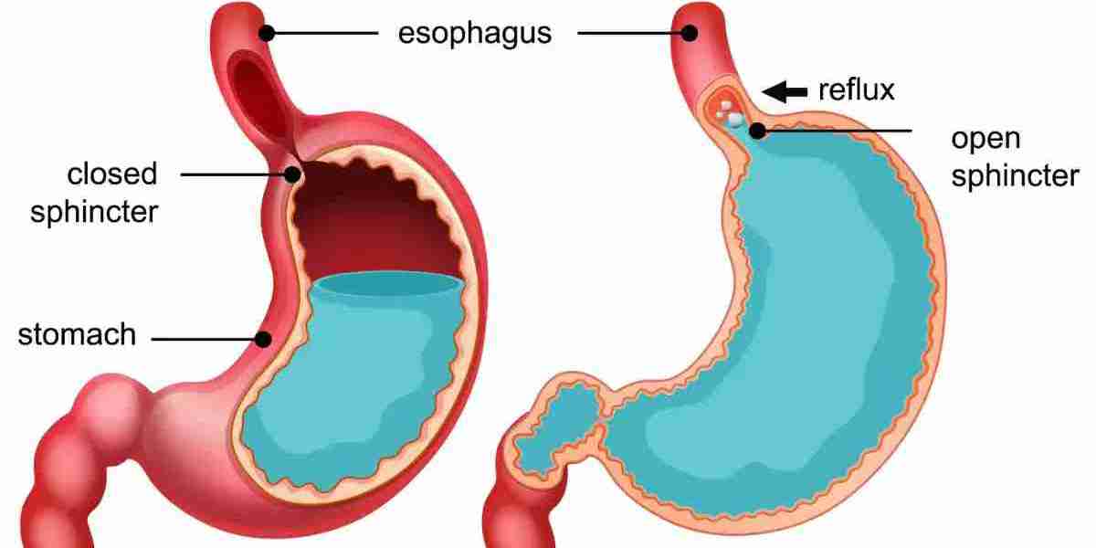 Best Dietary Practices to Manage Acid Reflux Symptoms