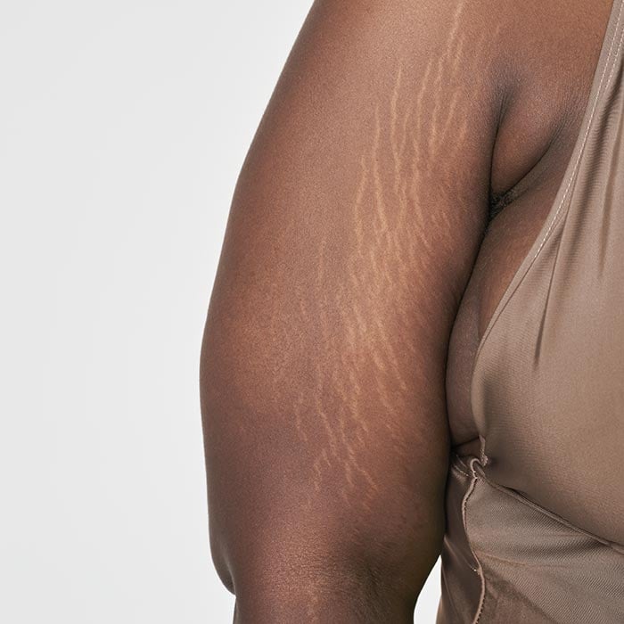 Professional Stretch Marks Treatment Services in Mississauga