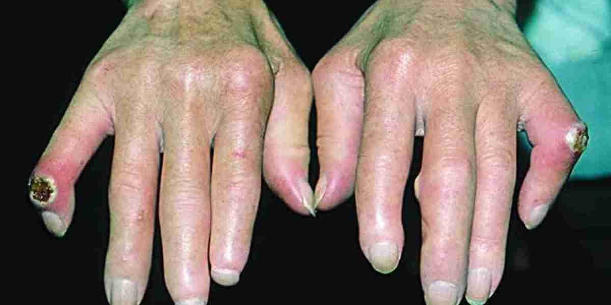 Scleroderma Market Analysis, Epidemiology, Trends and Forecast 2024-2034