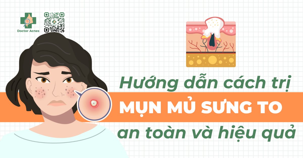 Hướng dẫn cách trị mụn mủ sưng to an toàn và hiệu quả