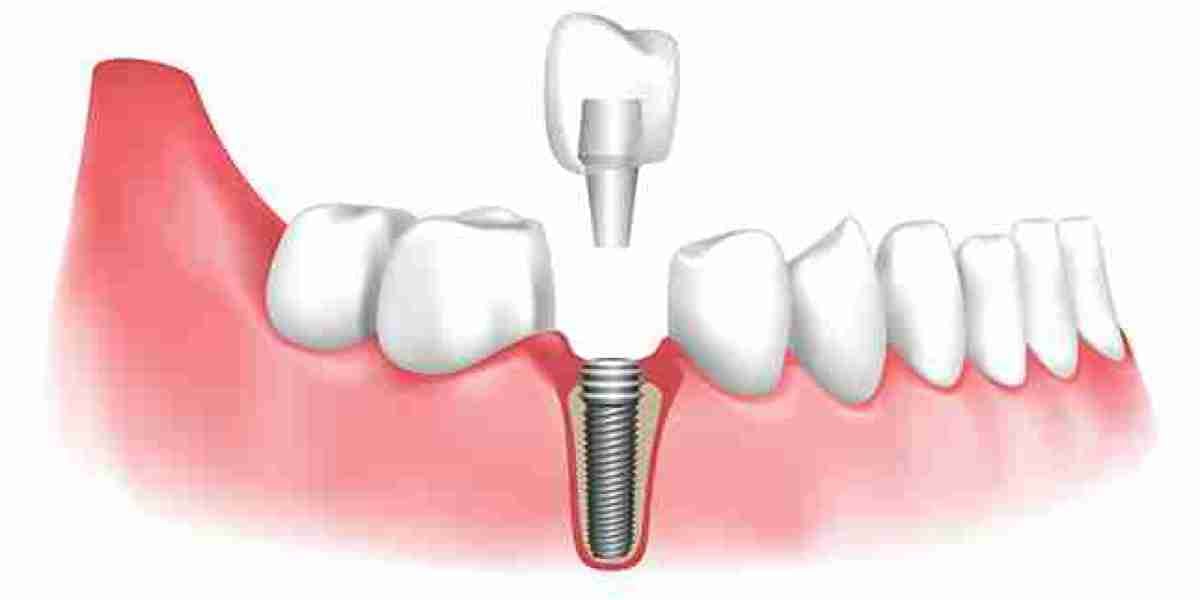 The Impact of Dental Implants on Oral Health: More Than Just a Smile Makeover