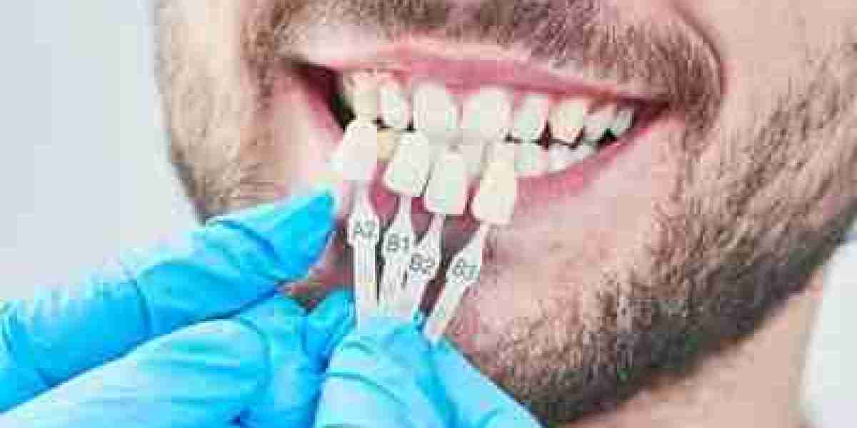 Dental Veneers: The Secret to Radiant Smiles