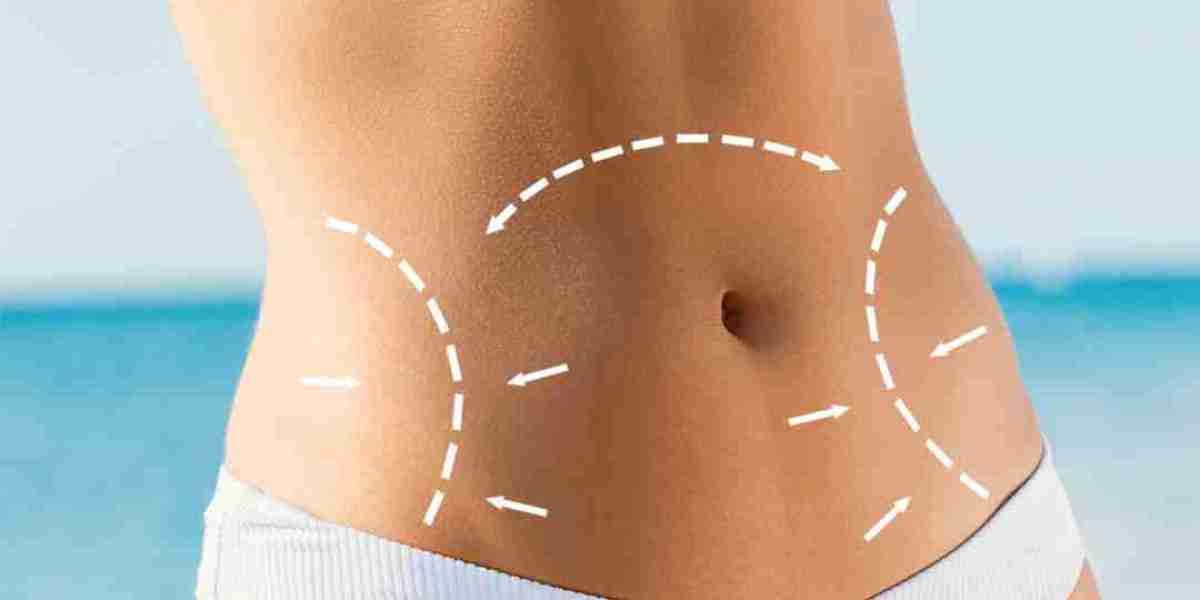 All You Need to Know About Tummy Tuck Surgery and Outcomes