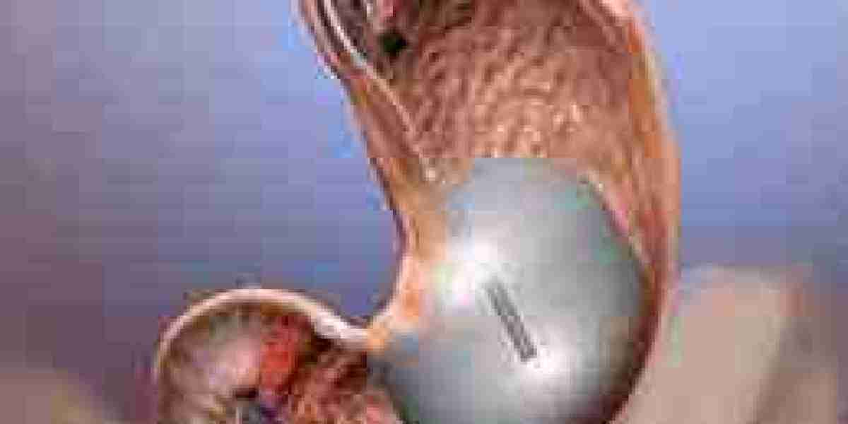 Choosing the Right Gastric Balloon Option in Dubai: What You Need to Know