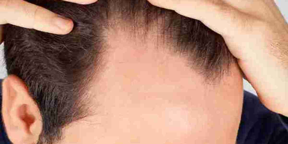 Hair Loss on Temples: Symptoms, Causes and Various Treatment Options | Kosmoderma Clinic in Delhi