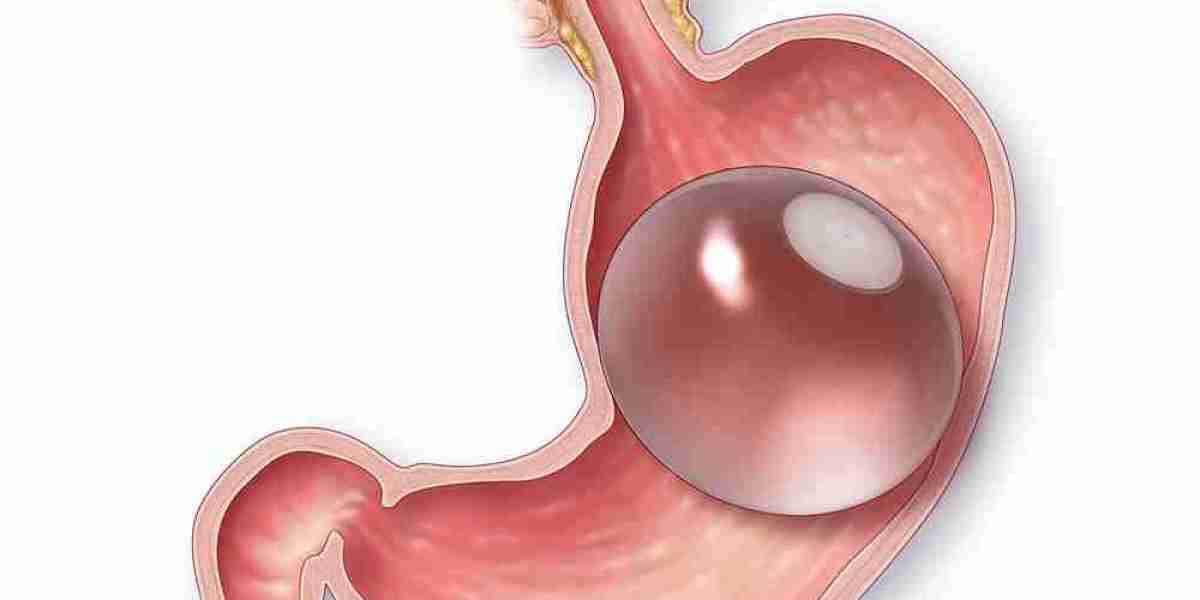 Choosing the Right Gastric Balloon Option in Dubai: What You Need to Know