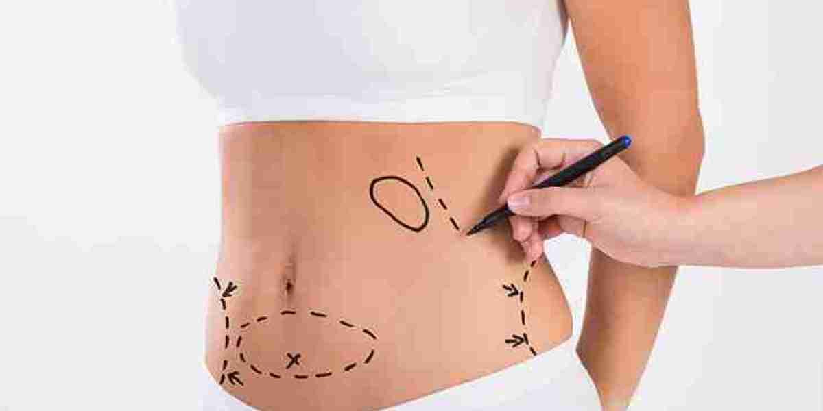 How to Maintain Your Results After Lipo Abdominoplasty in Dubai