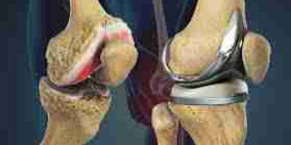 Top 5 Mistakes After Knee Replacement Surgery