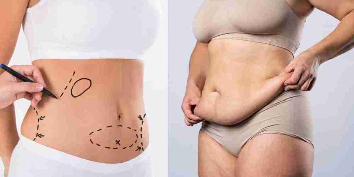 Liposuction in Dubai for Double Chin and Facial Fat Reduction