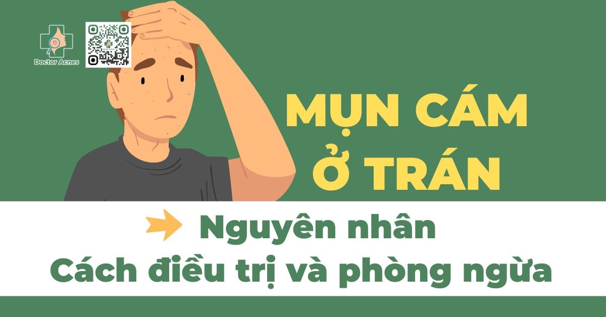 Mụn cám ở trán: nguyên nhân, cách điều trị và phòng ngừa