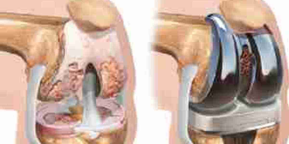 Before And After Knee Replacement Surgery