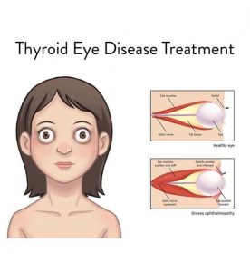 What is Thyroid Eye Disease? - Thyroid Eyes Treatment