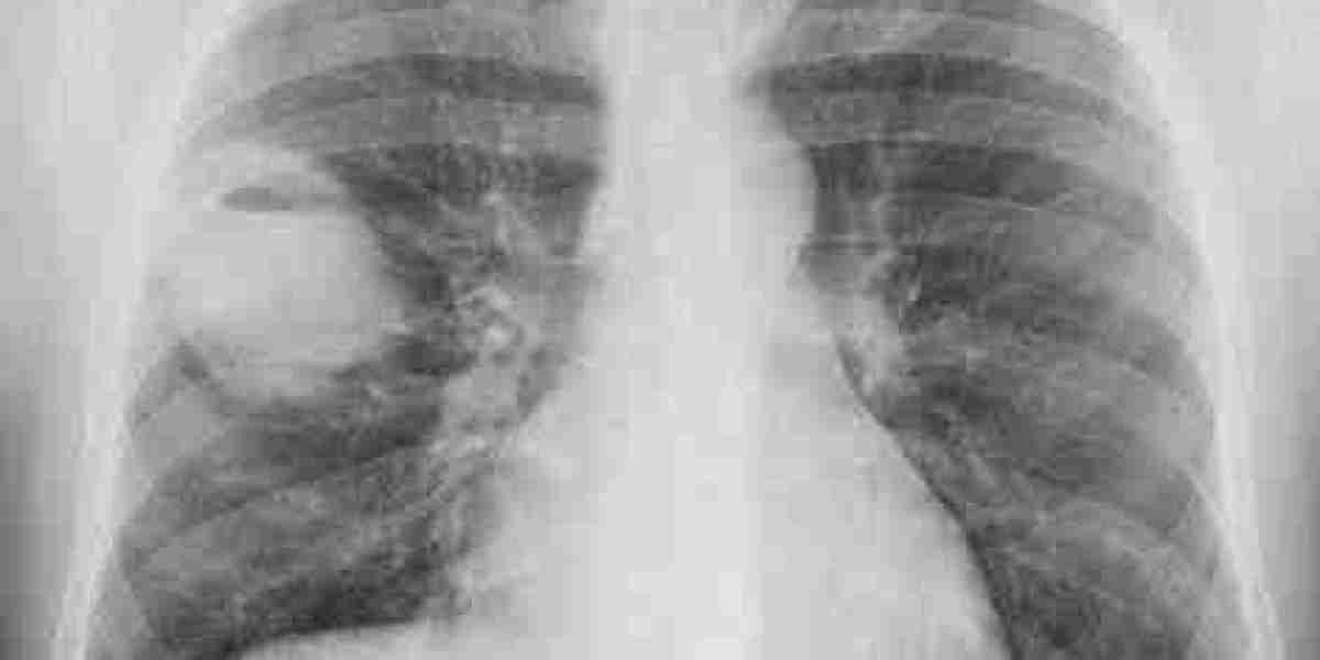 Pulmonary oedema and emphysema: Definition, causes, signs, and treatment options