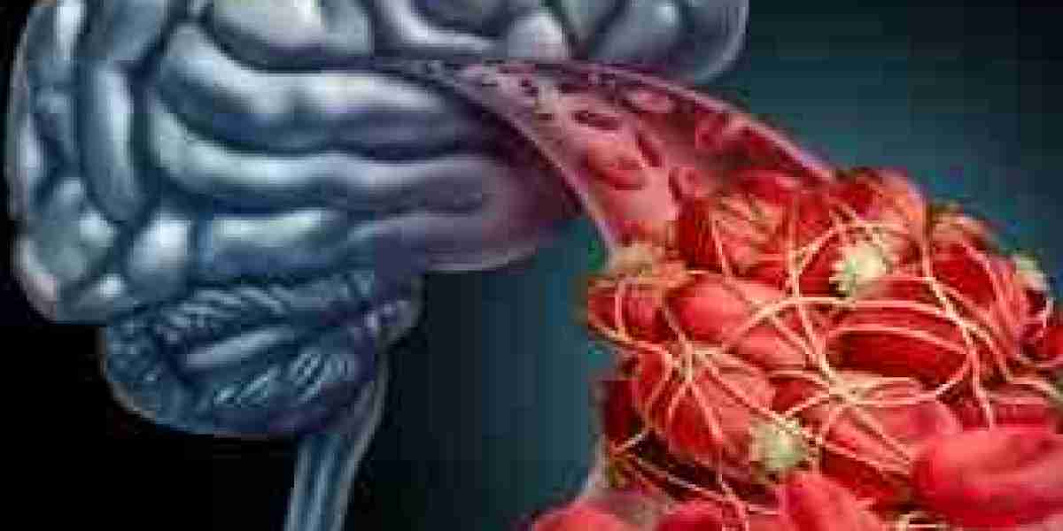 Transient Ischemic Attack Market Size, Share, Demand, Forecast, Dynamics Overview