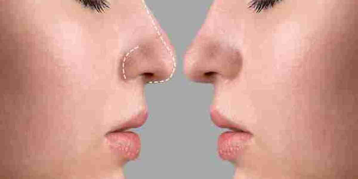 Choosing Between Cosmetic and Functional Rhinoplasty in Dubai