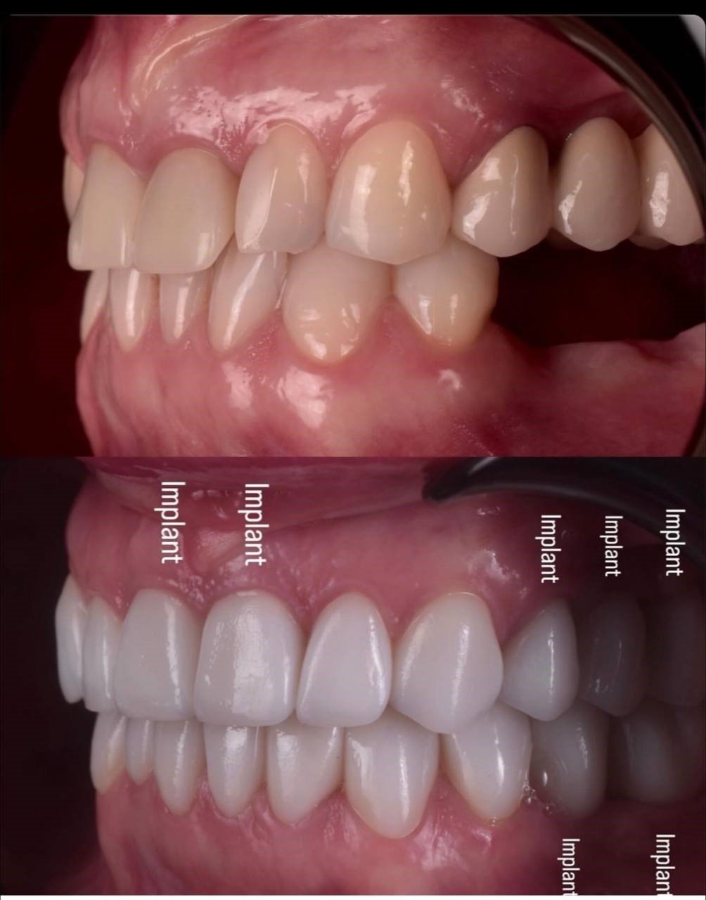 The Journey to a Perfect Smile: Dental Implants Make it Possible